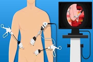 Laparoscopy