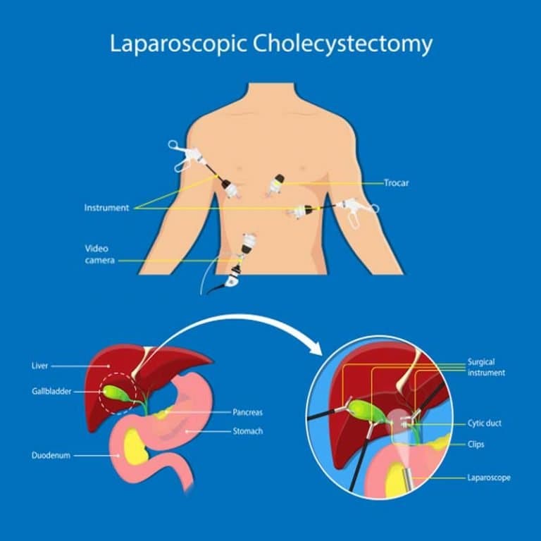 Laparoscopic Surgery
