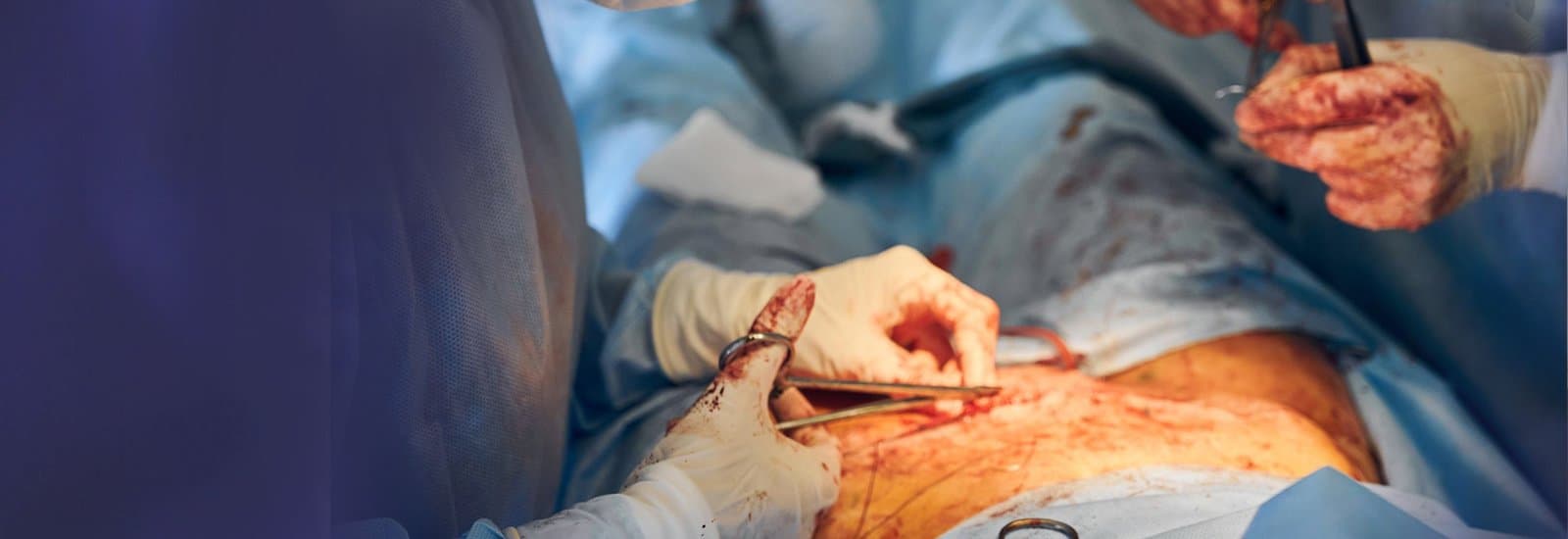 Laparoscopic Surgery